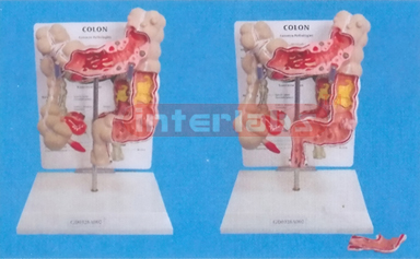 DESK TYPE,COMMON PATHOLOGIES OF COLON AND RECTUM MODEL WITH DESCRIPTION PLATE